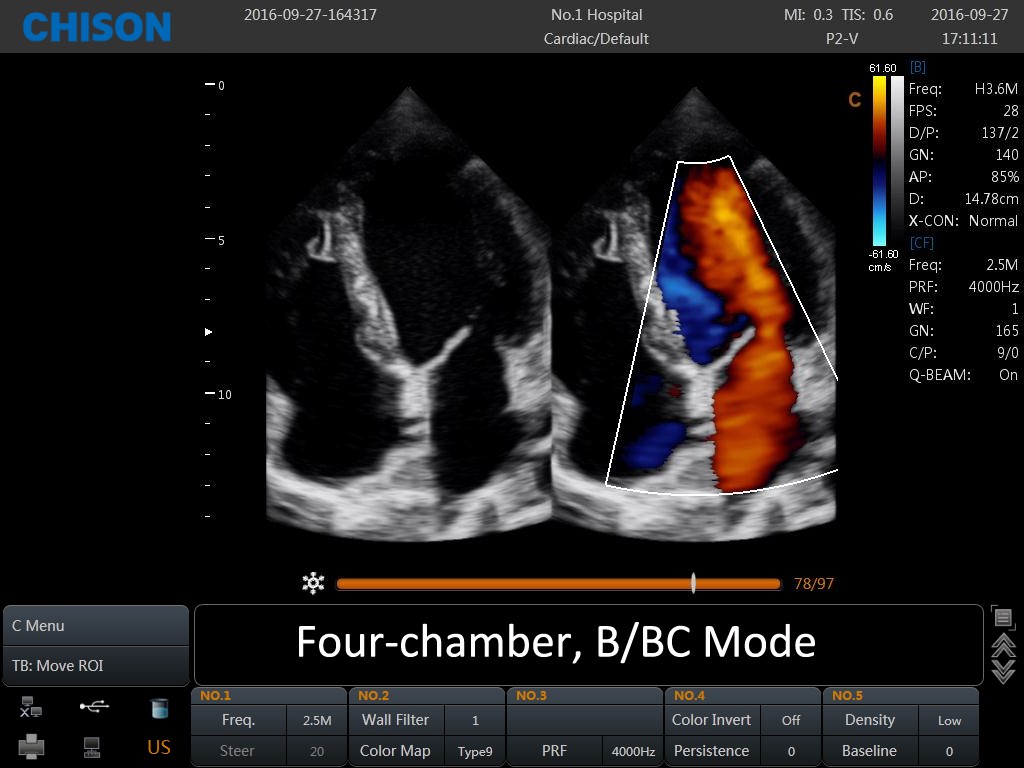 SonoBook Four chamber BBC mode